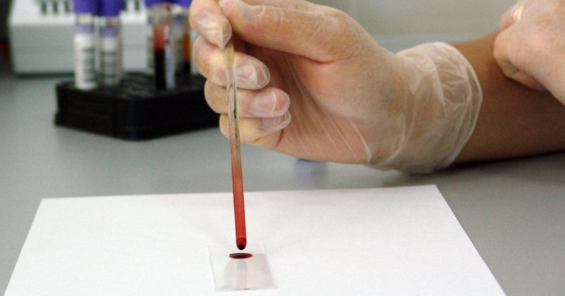 Nuevo tratamiento para el VIH logra disminuir su presencia en sangre